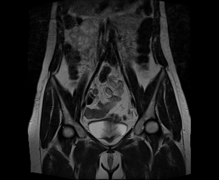 File:Bicornuate bicollis uterus (Radiopaedia 61626-69616 Coronal T2 12).jpg