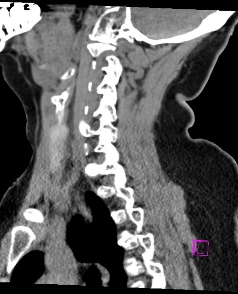 File:Bilateral atlanto-occipital assimilation (Radiopaedia 28350-28603 D 52).jpg