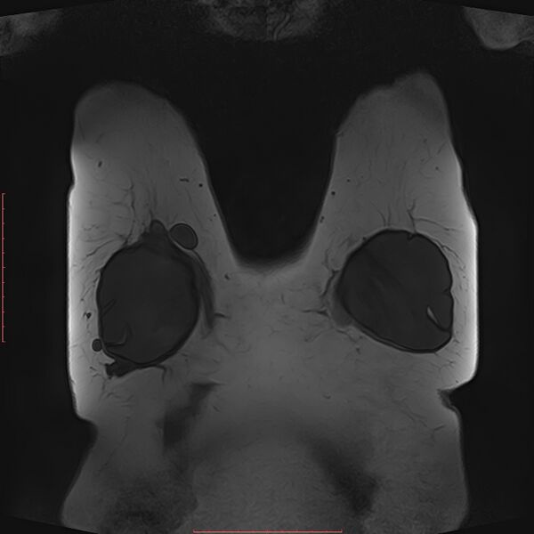 File:Bilateral breast implant rupture (Radiopaedia 24761-25027 G 57).jpg