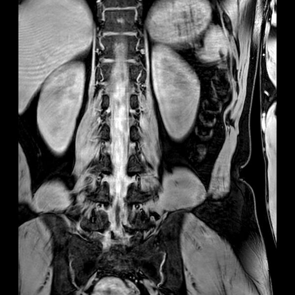 File:Bilateral conjoined nerve roots at different levels (Radiopaedia 73312-84063 B 31).jpg