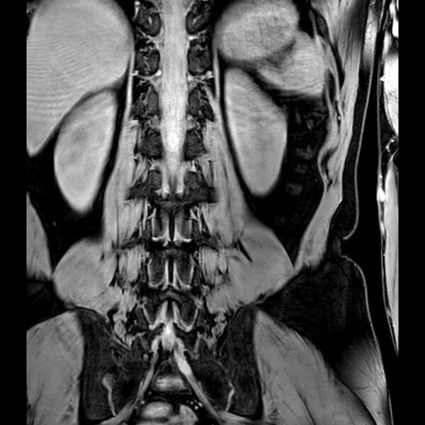 File:Bilateral conjoined nerve roots at different levels (Radiopaedia 73312-84063 B 35).jpg
