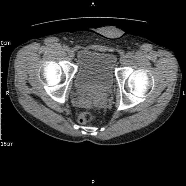 File:Bilateral medullary nephrocalcinosis with ureteric calculi (Radiopaedia 71269-81569 Axial non-contrast 125).jpg