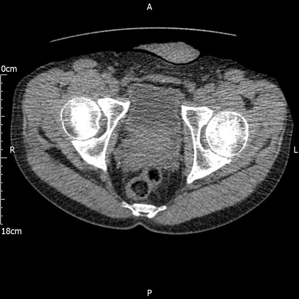 File:Bilateral medullary nephrocalcinosis with ureteric calculi (Radiopaedia 71269-81569 Axial non-contrast 127).jpg