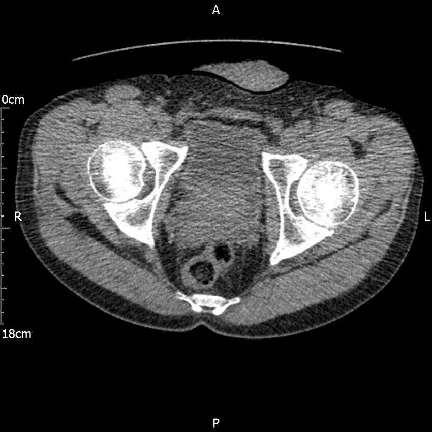 Bilateral medullary nephrocalcinosis with ureteric calculi (Radiopaedia 71269-81569 Axial non-contrast 127).jpg