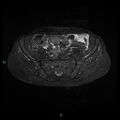 Bilateral ovarian fibroma (Radiopaedia 44568-48293 Axial STIR 6).jpg