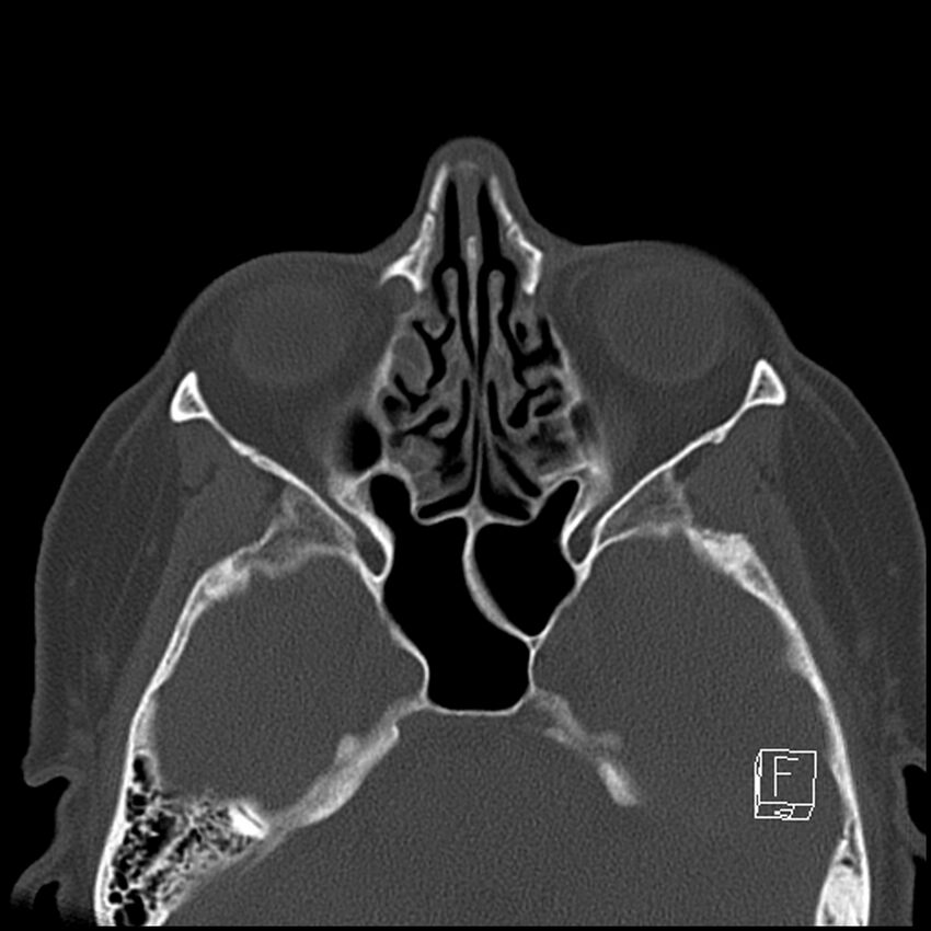 Bilateral palatine tonsilloliths on OPG and CT (Radiopaedia 75167-86247 Axial bone window 12).jpg