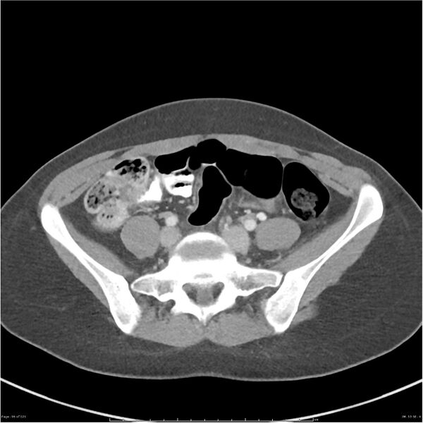 File:Bilateral ureteritis and cystitis (Radiopaedia 25340-25594 A 53).jpg
