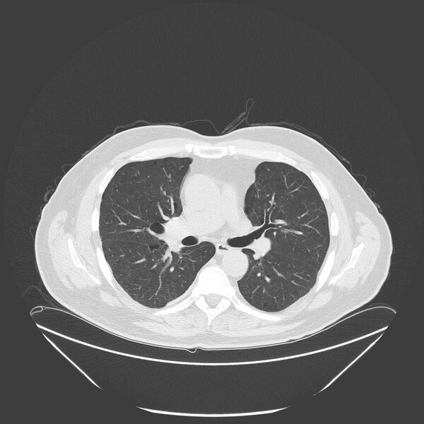 File:Birt-Hogg-Dubé syndrome (Radiopaedia 52578-58491 Axial lung window 28).jpg