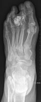 X-ray left foot: Bizarre parosteal osteochondromatous proliferation in 2nd toe