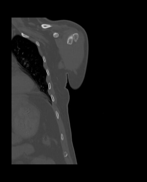 File:Bizarre parosteal osteochondromatous proliferation (Radiopaedia 84221-99501 Coronal bone window 6).jpg
