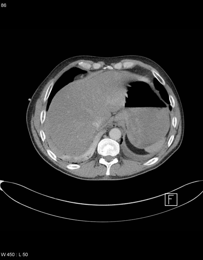 Boerhaave syndrome with tension pneumothorax (Radiopaedia 56794-63605 A 42).jpg