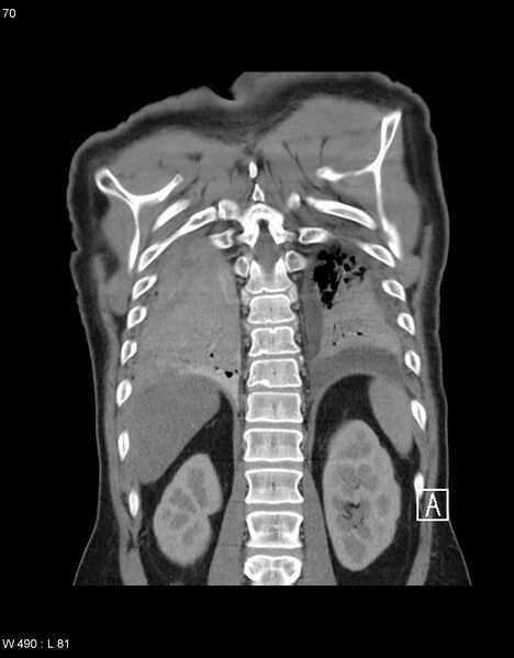 File:Boerhaave syndrome with tension pneumothorax (Radiopaedia 56794-63605 B 30).jpg
