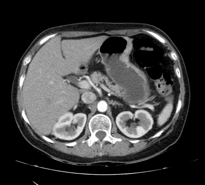 File:Bosniak renal cyst - type IV (Radiopaedia 22929-22953 B 28).jpg