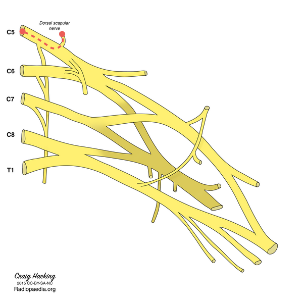 File:Brachial plexus (diagram) (Radiopaedia 37612-39492 F 1).png