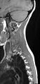 Brachial plexus birth palsy (Radiopaedia 68118-77604 Sagittal T1 12).jpg