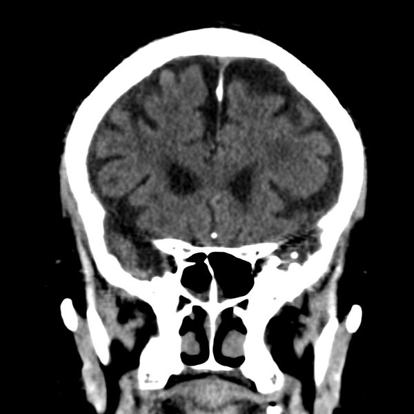 File:Brain Pantopaque remnants (Radiopaedia 78403-91048 Coronal non-contrast 24).jpg