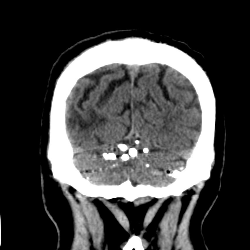 Brain Pantopaque remnants (Radiopaedia 78403-91048 Coronal non-contrast 60).jpg