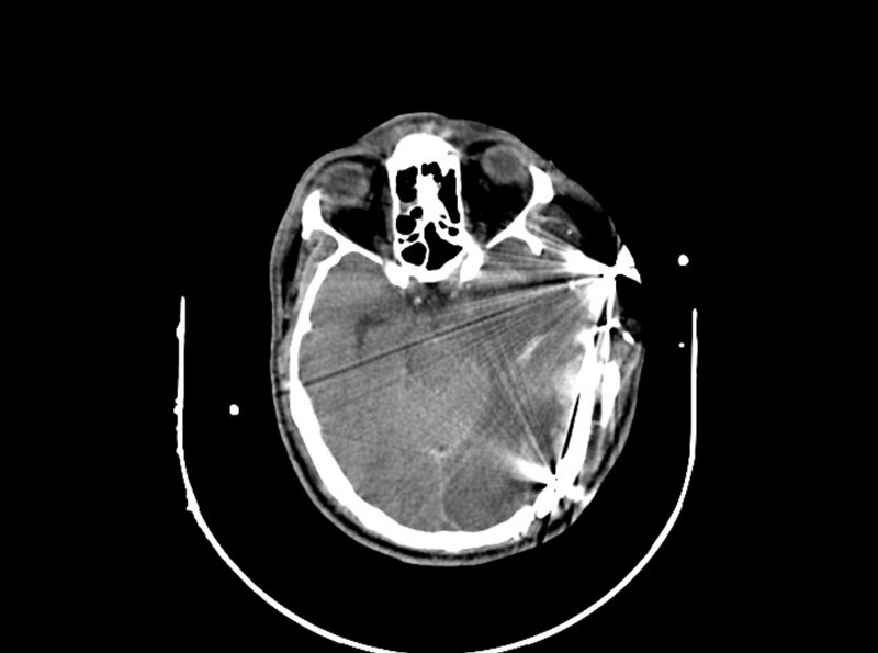 File:Brain injury by firearm projectile (Radiopaedia 82068-96087 B 85).jpg