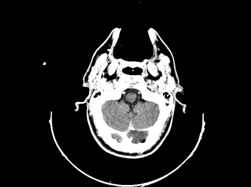 File:Brain injury by firearm projectile (Radiopaedia 82068-96088 B 67).jpg