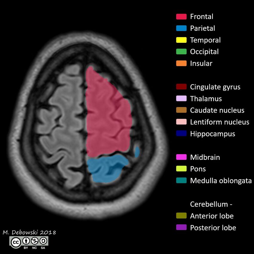 Brain lobes - annotated MRI (Radiopaedia 61691-69700 Axial 8).JPG