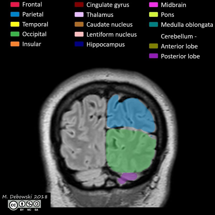 Brain lobes - annotated MRI (Radiopaedia 61691-69700 Coronal 65).JPG