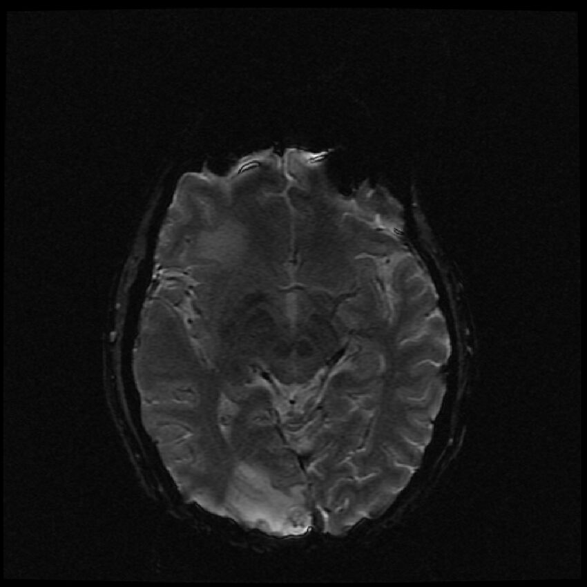 Brain metastases (renal cell carcinoma) (Radiopaedia 42571-45704 Axial SWI 35).jpg