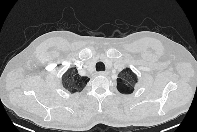 File:Brain metastases - lung cancer primary (Radiopaedia 75060-86116 Axial lung window 3).jpg