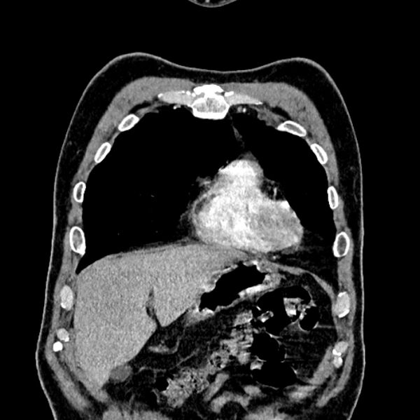 File:Brain metastases - lung cancer primary (Radiopaedia 75060-86116 C+ arterial phase 9).jpg