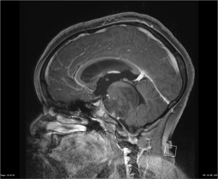 File:Brainstem glioma (Radiopaedia 21819-21775 D 22).jpg