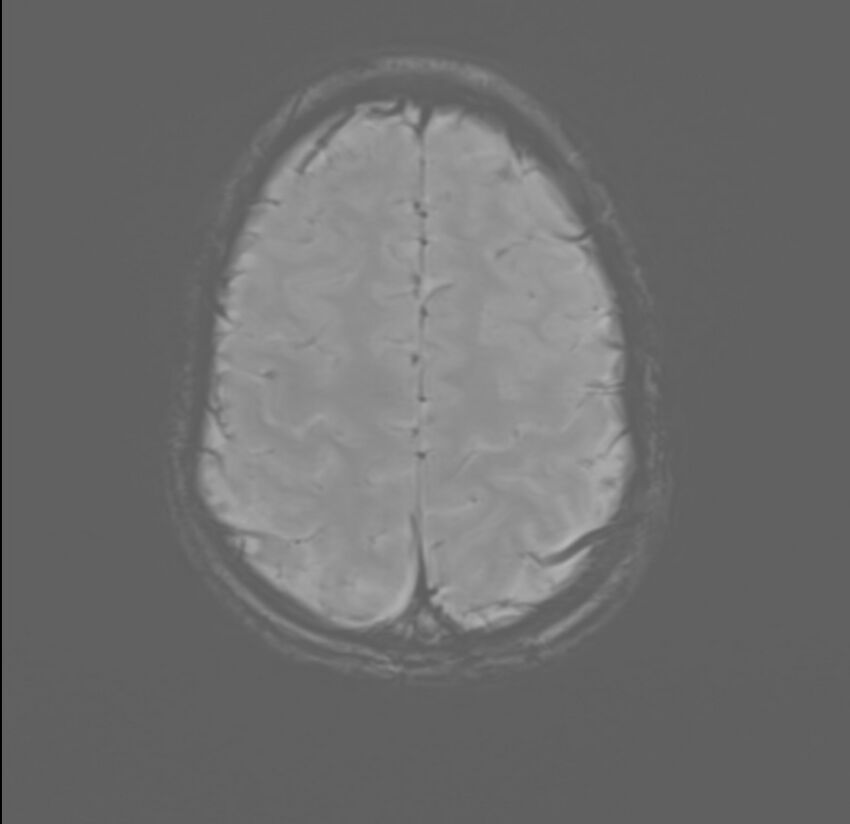 Brainstem glioma (Radiopaedia 70548-80674 Axial SWI 53).jpg