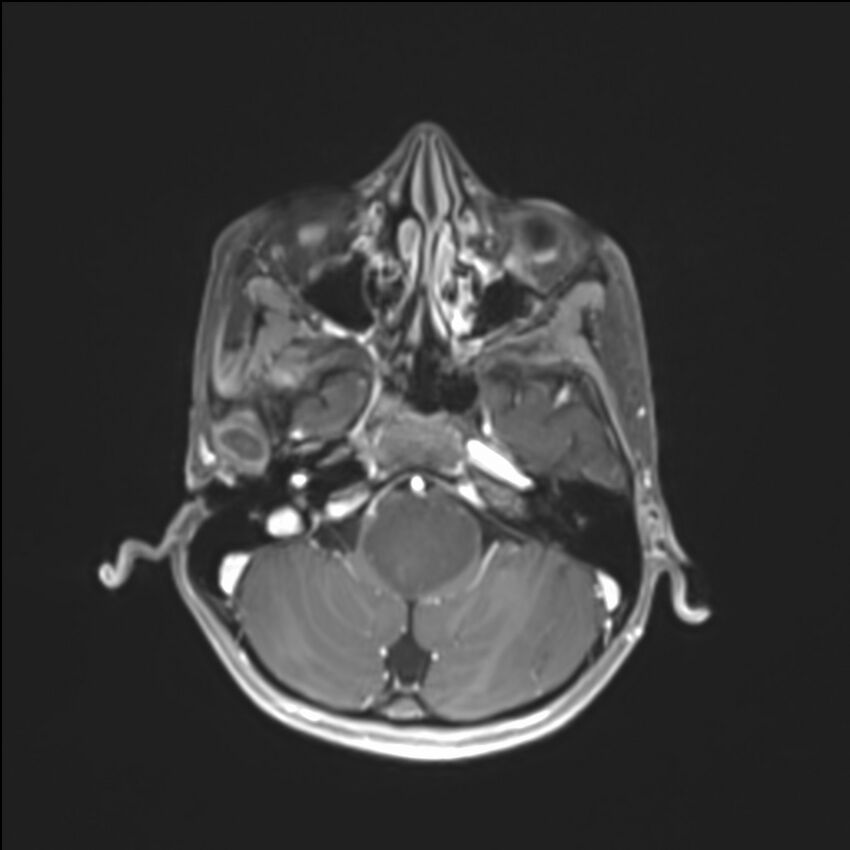 Brainstem glioma (Radiopaedia 70548-80674 Axial T1 C+ 37).jpg