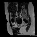 Broad ligament fibroid (Radiopaedia 49135-54241 Sagittal T2 19).jpg