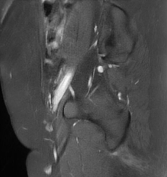 File:Broad ligament leiomyoma (Radiopaedia 81634-95516 G 5).jpg