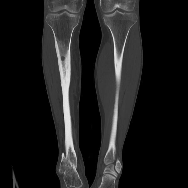 File:Brodie abscess - tibia (Radiopaedia 66028-75204 Coronal bone window 34).jpg