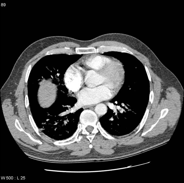 File:Bronchial arterial aneurysm (Radiopaedia 22293-22330 A 1).jpg