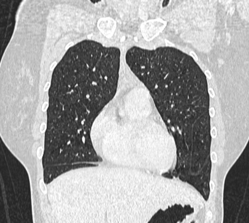 Bronchial atresia (Radiopaedia 50007-55297 Coronal lung window 25).jpg