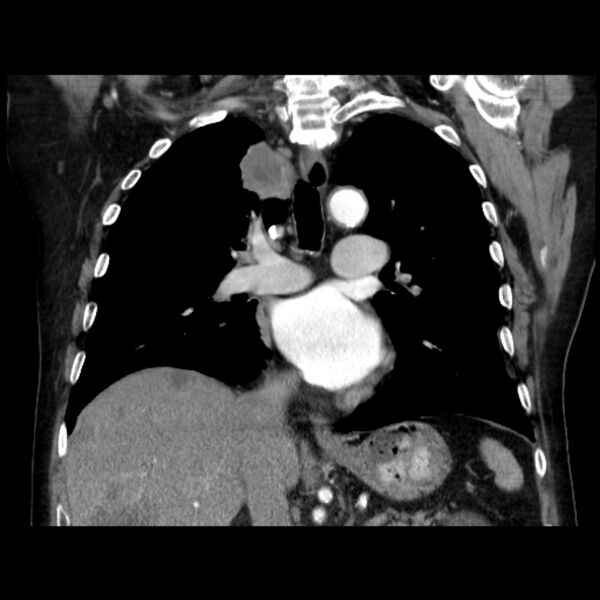 File:Bronchogenic adenocarcinoma and pulmonary embolism (Radiopaedia 9097-9806 C 27).jpg