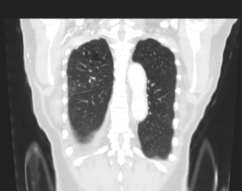 Bronchogenic carcinoma with lymphangitic spread (Radiopaedia 29002-29357 Coronal lung window 58).jpg