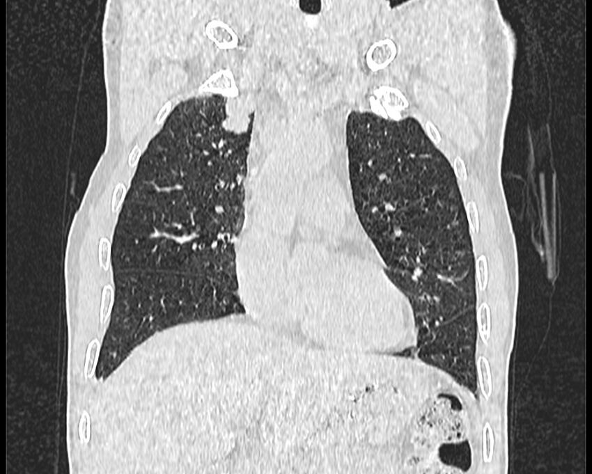 Bronchogenic carcinoma with superior vena cava syndrome (Radiopaedia 36497-38054 Coronal lung window 5).jpg