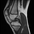 Bucket handle tear - lateral meniscus (Radiopaedia 72124-82634 Sagittal T1 10).jpg