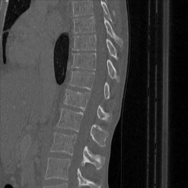 File:Bulging of paraspinal line in traumatic thoracal spinal compression fracture (Radiopaedia 29221-35872 Sagittal bone window 24).jpg