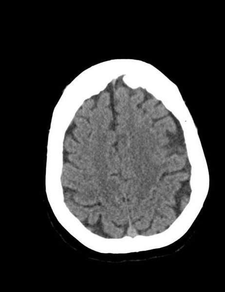 File:Burnt-out meningioma (Radiopaedia 51557-57337 Axial non-contrast 35).jpg