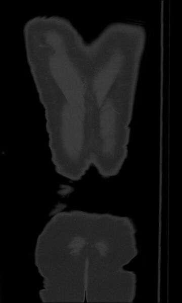 File:Burst fracture (Radiopaedia 83168-97542 Coronal bone window 72).jpg