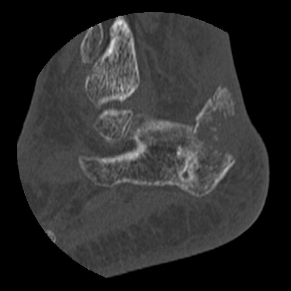 File:Calcaneal tuberosity avulsion fracture (Radiopaedia 22649-22668 D 6).jpg