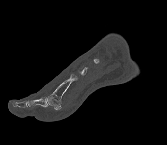 File:Calcaneal tuberosity avulsion fracture (Radiopaedia 22649-22668 Sagittal bone window 43).jpg