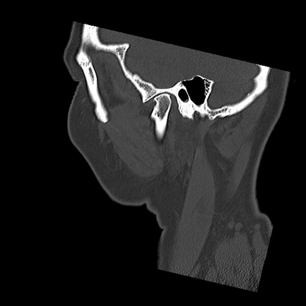 File:Canal up mastoidectomy (Radiopaedia 78108-90638 Sagittal bone window 11).jpg