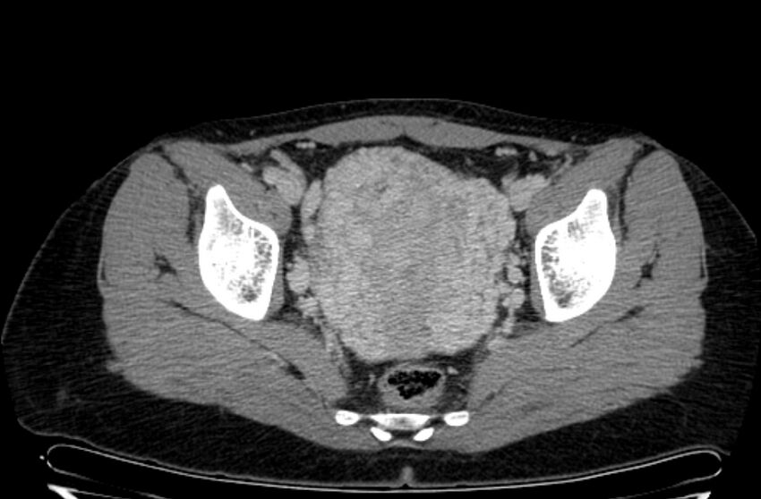 Cannonball metastases - uterine choriocarcinoma (Radiopaedia 70137-80174 A 31).jpg