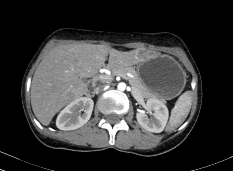 File:Cannonball metastases from breast cancer (Radiopaedia 91024-108569 A 130).jpg