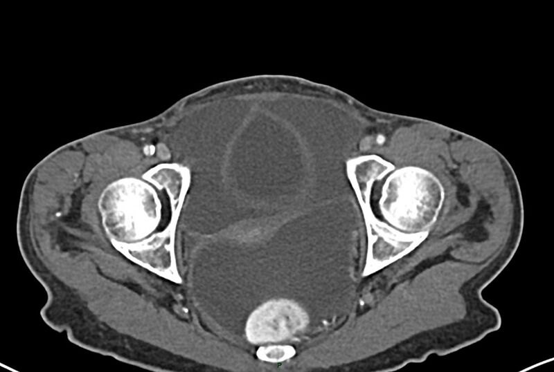 File:Carcinoid mesenteric tumor complicated by chylous ascites (Radiopaedia 76312-87953 A 74).jpg