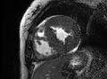 Cardiac amyloidosis (Radiopaedia 61600-69579 Short axis bSSFP 139).jpg